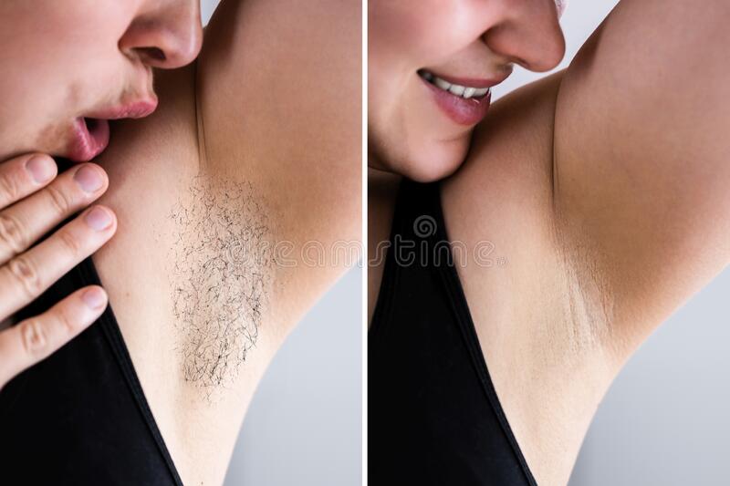 Laser Hair Removal before and after Images